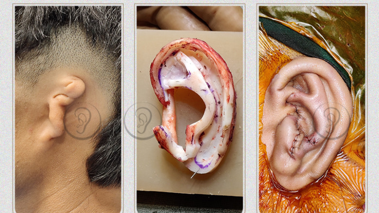 Ear Reshaping Surgery in Mumbai, India, USA