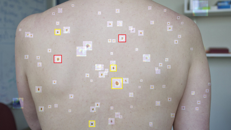 Does Mohs Surgery Really Cure Skin Cancer?