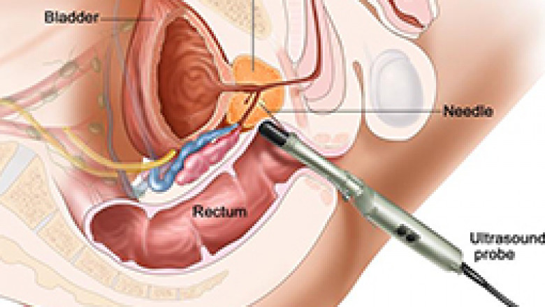 Prostate Cancer Hospitals in India