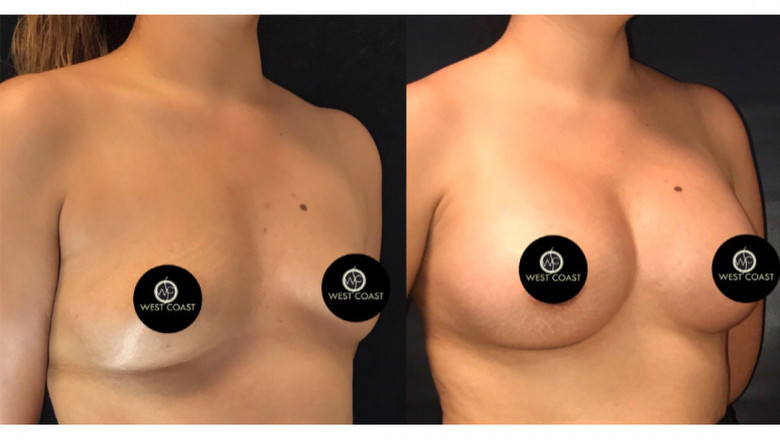 Non-Surgical Capsular Contracture Treatment