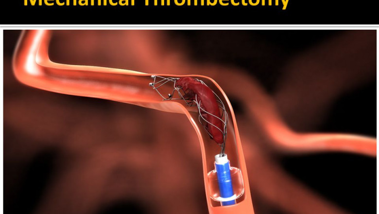 Mechanical Thrombectomy Devices Market 2022 Demand, Size, Share, Growth Opportunities, Segmentation, Trends and Forecast to 2025 |Research Informatic