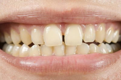 General Dentists and Restorative Procedures