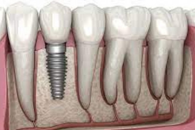 Dental Implants Market Insights, Technological Advancements, and Forecast to 2029