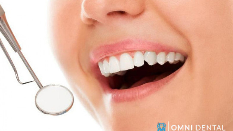 7 Advantages of Professional Teeth Whitening