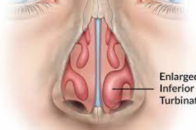 Diode Laser--One of the Effective and Economical treatment for ITH (Inferior Turbinate Hypertrophy)