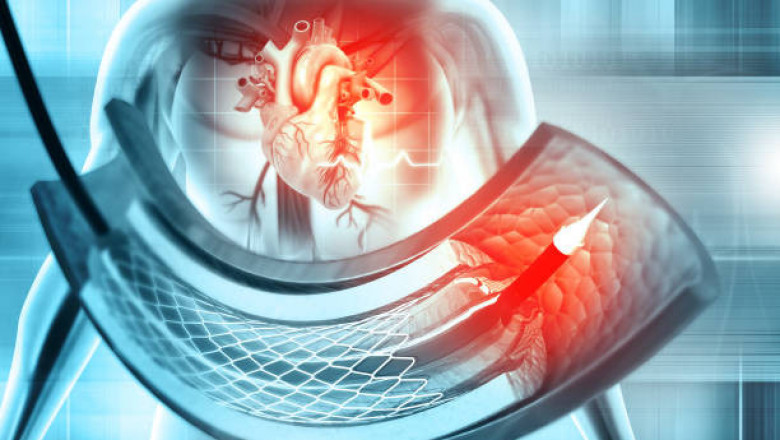 Interventional Cardiology Market Value Chain, Growth, Trends, Huge Business Opportunity 2027