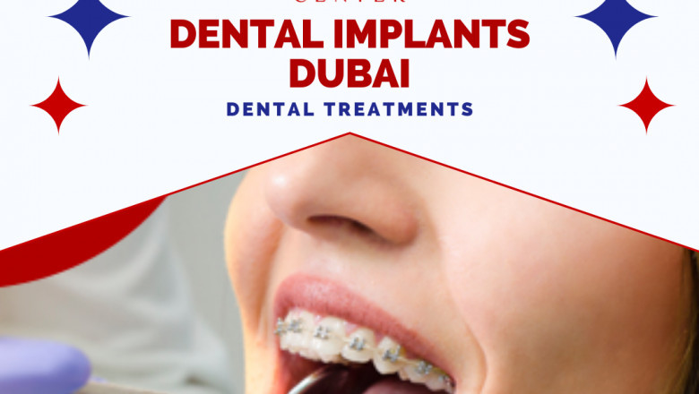 Dental implants Dubai