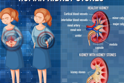 What Are The Locations Of Kidney Stones?