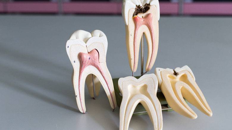 What Are The Stages Of Root Canal Treatment?