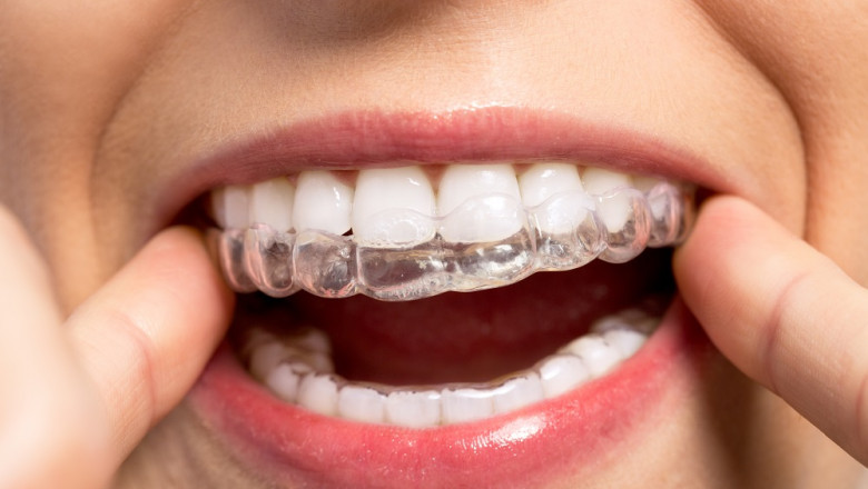 Why Do Dentists Suggest Wearing Mouthguards For Teeth?