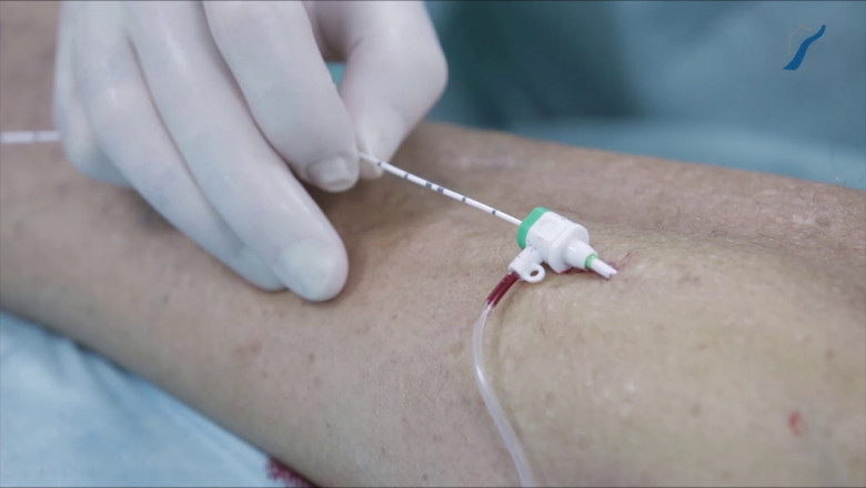 Is Medical Treatment Necessary For Varicose And Spider Veins?