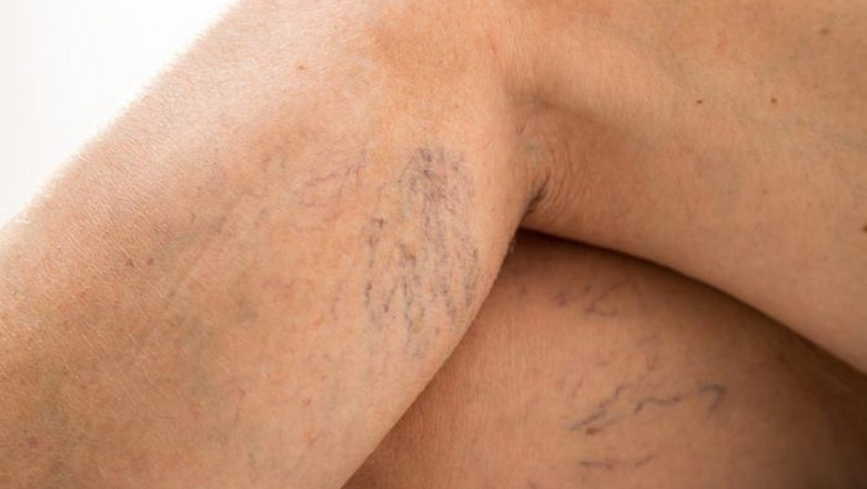 Is It Worth Visiting A Vein Specialist For Varicose Vein Treatment?