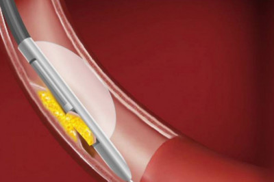 Rotational Atherectomy Theropy in Pune | Dr. Kartik Bhosale