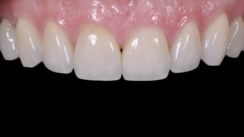 What Are The Advantages Of Dental Veneers?