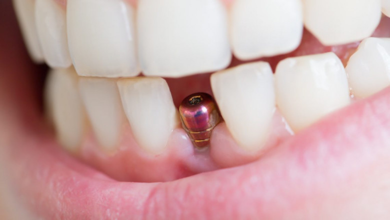 What Should We Know About Dental Implants?