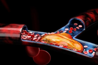 Global Aspiration Catheters Market Trends, Competitive Landscape, SWOT Analysis and Growth by 2022-2027