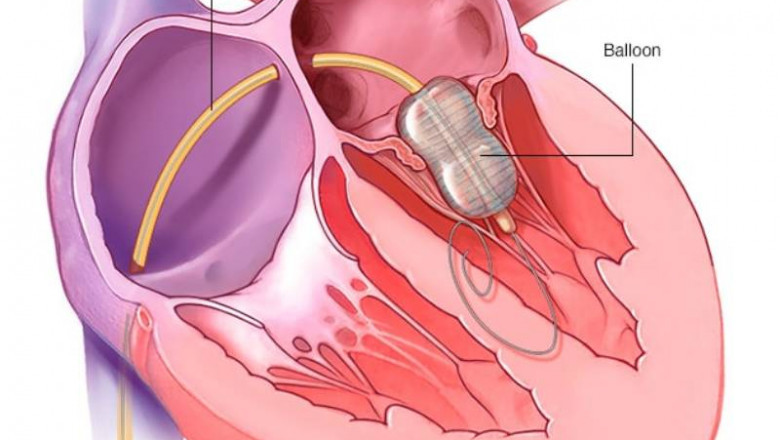 Balloon Valvuloplasty in Pune | Dr. kartik Bhosale