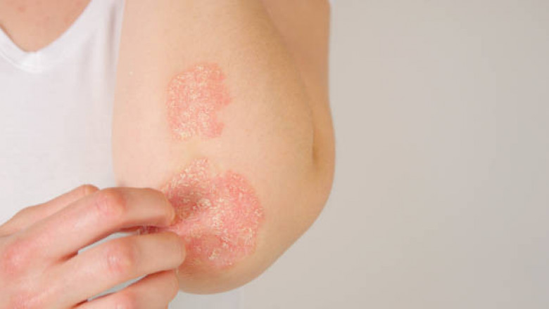 Psoriasis Treatment Market Scenario, Global Analysis By International Prestigious Players, Industry Demand and Trends by Forecast 2027