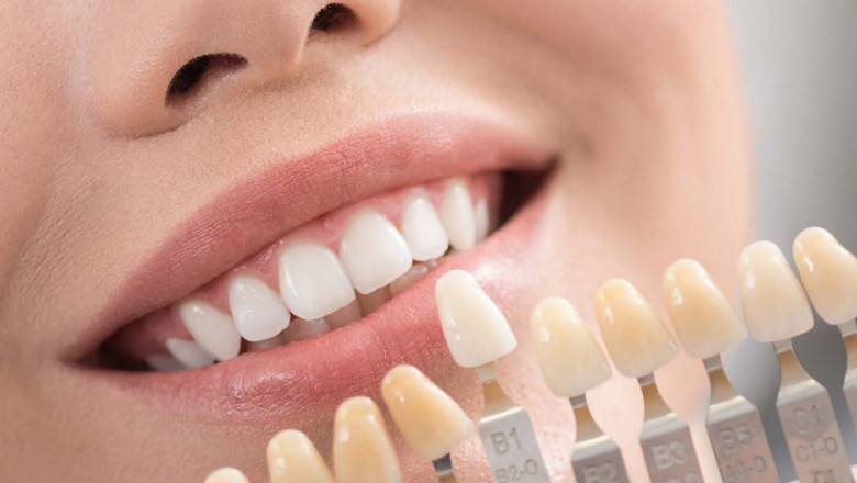 Veneers - What Are They?