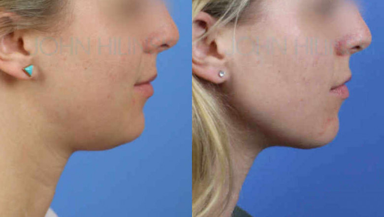 What Exactly Is Neck Liposuction?