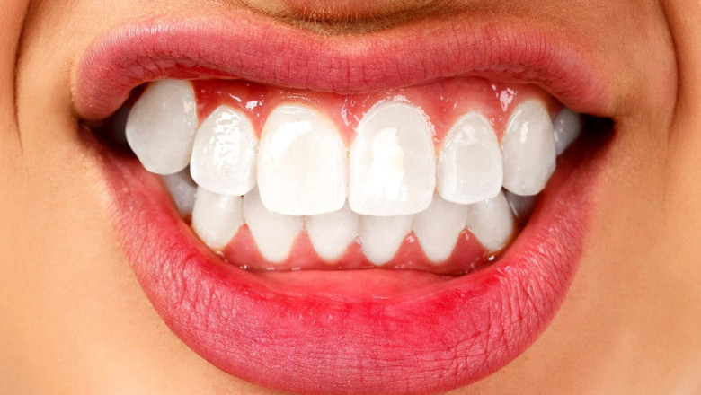 What Is Teeth Grinding?
