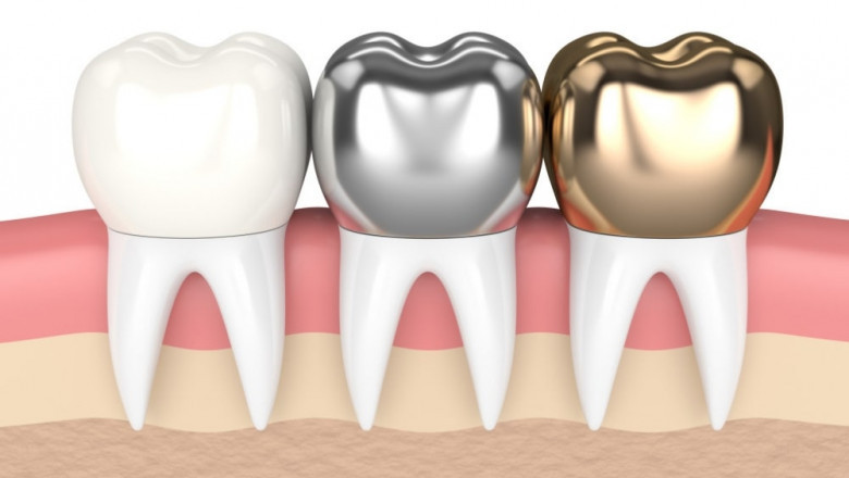 Are Fully Aware Of Dental Crowns?