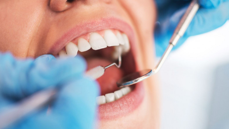 What Are The Essential Things To Know About Dental Veneers?