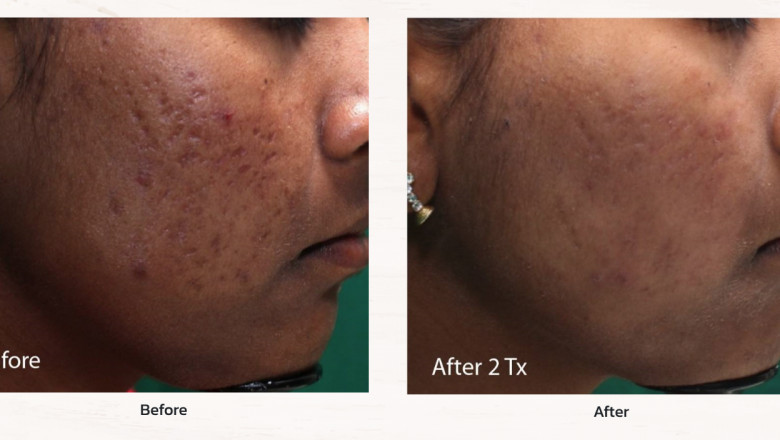 What To Count on From An Acne Treatment Clinic