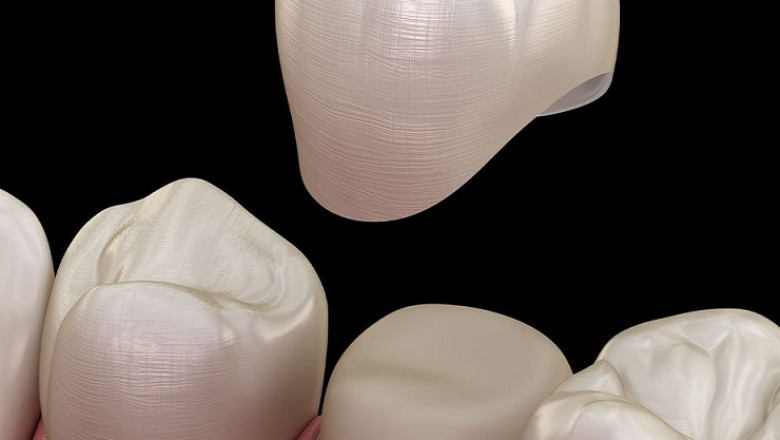 Dental Crown Market – Global Industry Trends & Forecast to 2028