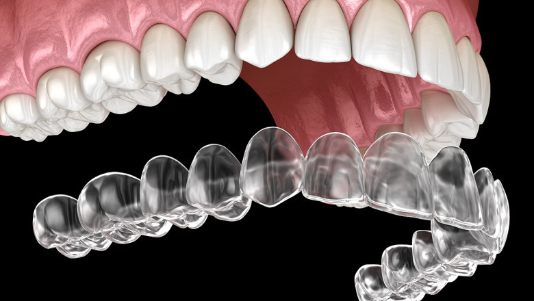 What Do You Know About Invisalign Clear Aligners?