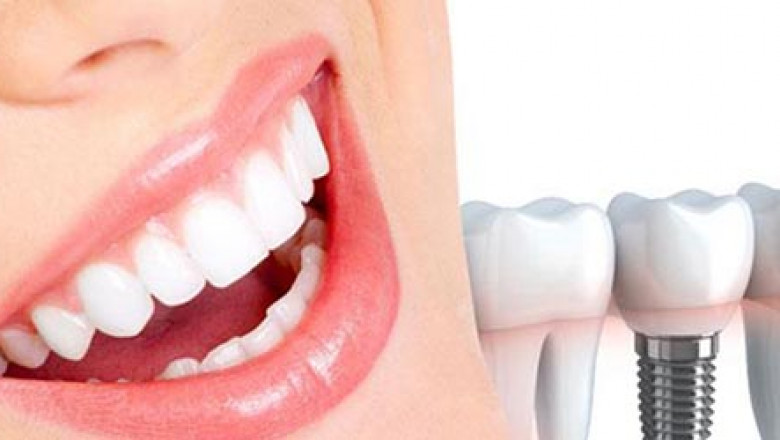 Are Dental Implants Painful?
