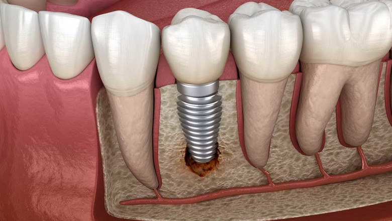 Can You Describe The Main Benefits and Advantages Of Dental Implants?