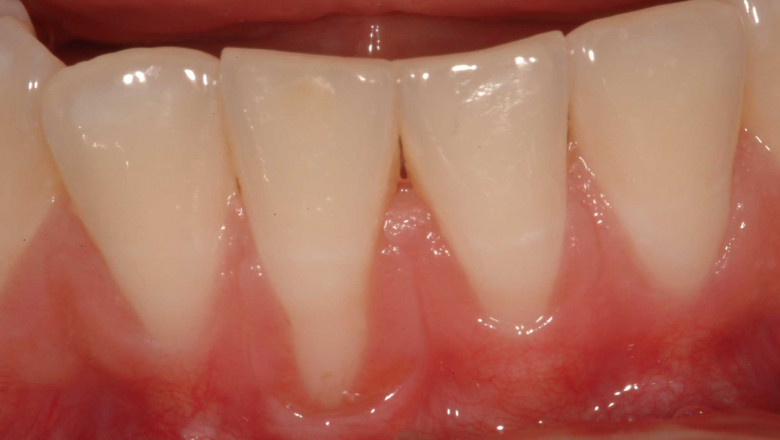 How Do Dentists Treat Gum Recession?