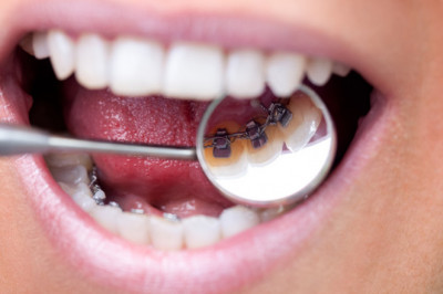 Veneers and Their Benefits - Tower House Dental Clinic