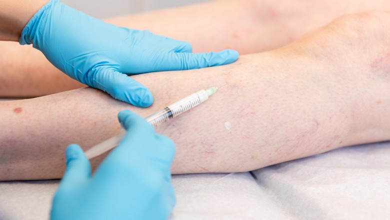 What Are The Effective Varicose Vein Treatment Procedures?