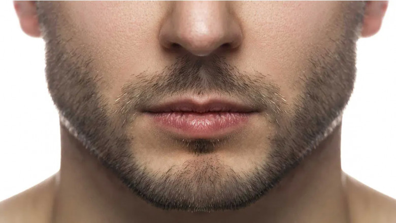How Fillers Are Used for Male Jawline Contouring