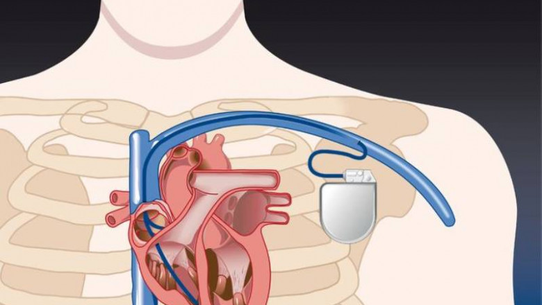Pacemaker Implantation in Pune | Dr. Kartik Bhosale