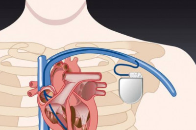 Pacemaker Implantation in Pune | Dr. Kartik Bhosale