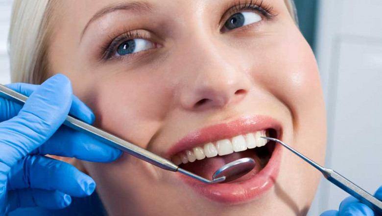 What Are The Benefits Of Veneers?
