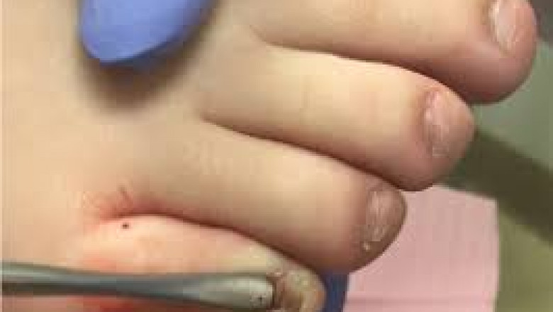 What is the Treatment for a Fungal Nail Infection