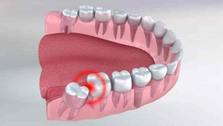 Why Is Wisdom Teeth Removal Important?