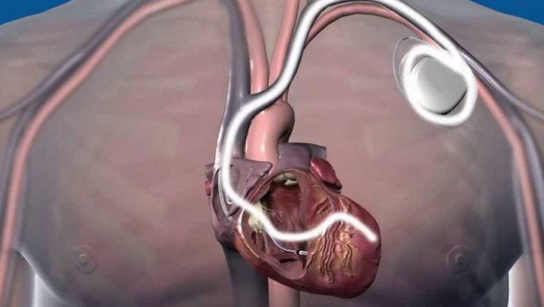 ICD or CRT Implantation in Pune | Dr. Kartik Bhosale