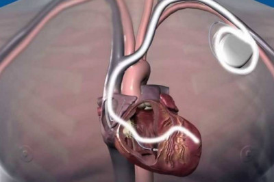 ICD or CRT Implantation in Pune | Dr. Kartik Bhosale