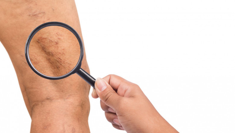 What Are The Ways To Strengthen Your Veins Naturally At Home?