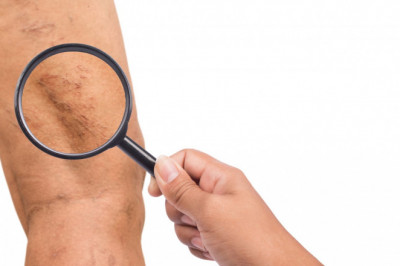 What Are The Ways To Strengthen Your Veins Naturally At Home?