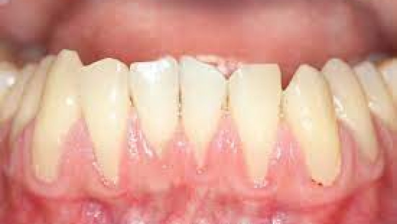 Can We Replace Dental Crown?