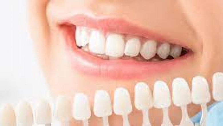 How To Select The Best Veneers For Your Face?
