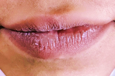 Lip Depigmentation with Laser
