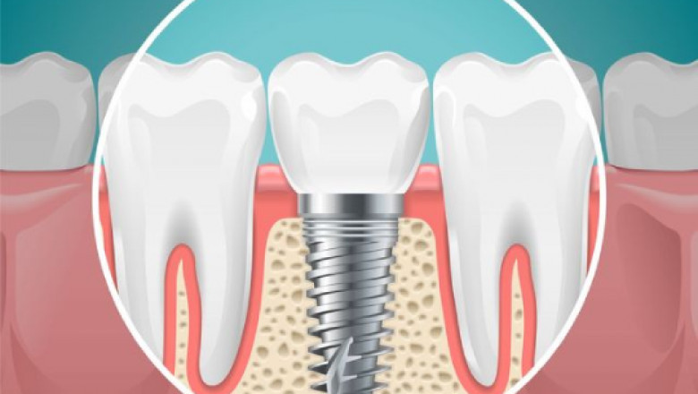 The Top 10 Benefits of Dental Implants