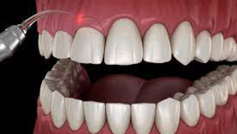 What Are Major Benefits Of Laser Surgery For Gingivitis?